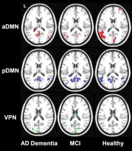 Cheap Vpn In Calhoun Ms Dans A Study Of within-subject Reliability Of the Brain's Default-mode ...