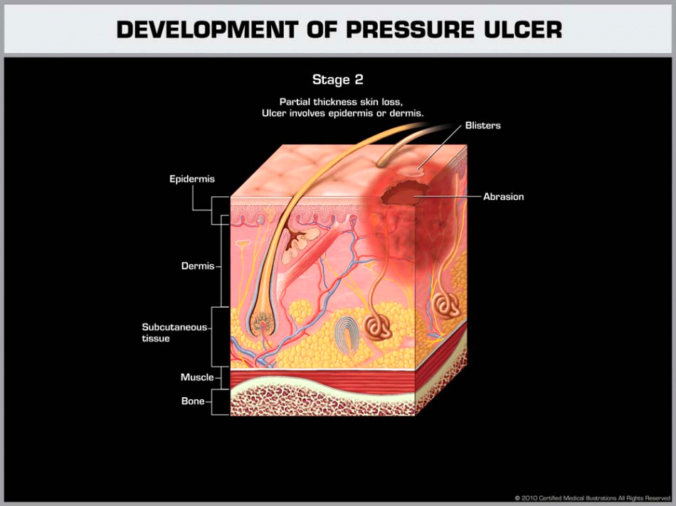 Injury Lawyer Cherry Hill Dans New Jersey Nursing Home attorney Bedsores & Ulcer Injury