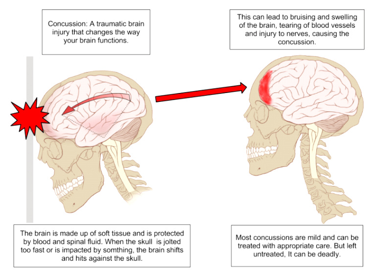 Houston Brain Injury Lawyer Dans What is A Concussion