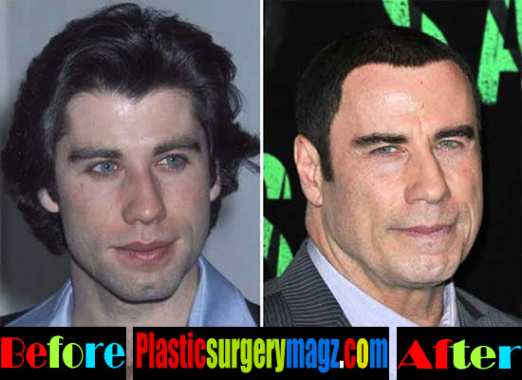 Lawyer for Surgery Gone Wrong Dans John Travolta Plastic Surgery John Travolta Face Plastic