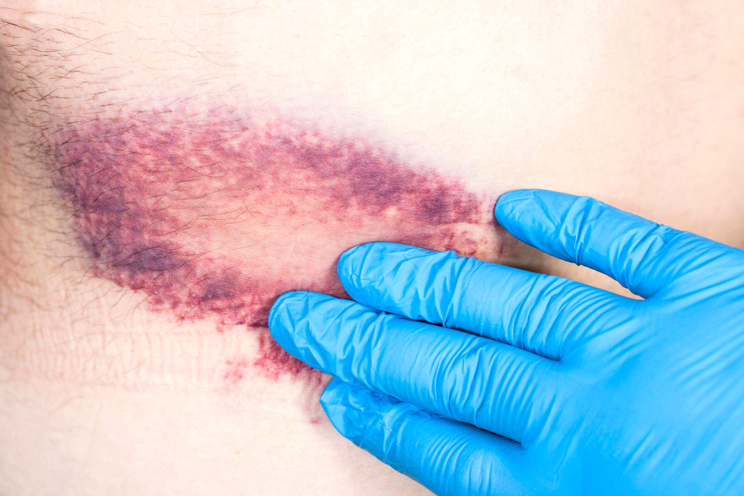 Personal Injury Lawyer Dog Bite Dans What Causes Bruises On Older Adults