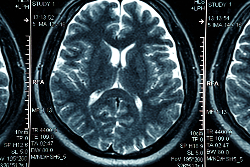 Nyc Brain Injury Lawyer Dans Small Head Injuries Can Lead to Big Health Problems Contact A Brain