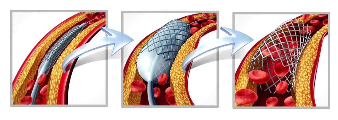 Personal Injury Lawyer Long Beach Dans Unnecessary Stent Procedures
