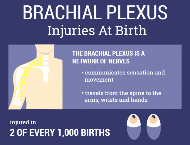 Pennsylvania Birth Injury Lawyer Dans Brachial Plexus Injury Lawsuit